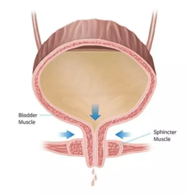 Stress-Urinary-Incontinence