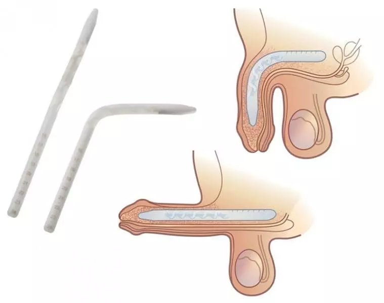 The_Genesis™_Flexible_Rod_Penile_Implant