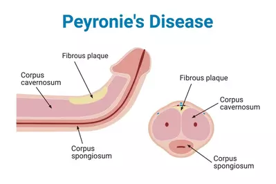peyronie's disease diagram